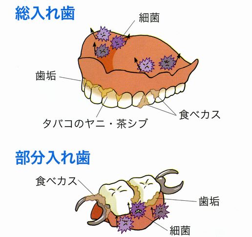 入れ歯は毎日洗うのでしょうか 入れ歯はこまめに洗いましょう デンタル オフィス ケイ スタッフ ブログ